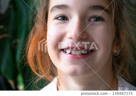 Smiling child after orthodontic plate treatment, example of early intervention and pediatric bite correction. Smiling child after orthodontic plate treatment, example of early intervention and pediatric bite correction. 136987155