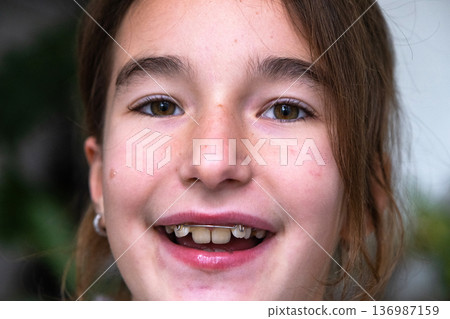 Young girl age 9 showing smile with crooked teeth, removable orthodontic plate for jaw correction. 136987159