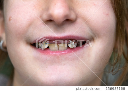 Smile with visible gaps in mixed dentition, ready for orthodontic correction and expansion plate fitting. Smile with visible gaps in mixed dentition, ready for orthodontic correction and expansion plate fitting. 136987166