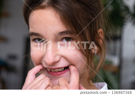 Child putting on blue orthodontic plate, pediatric appliance for smile correction and tooth alignment. Child putting on blue orthodontic plate, pediatric appliance for smile correction and tooth alignment. 136987168