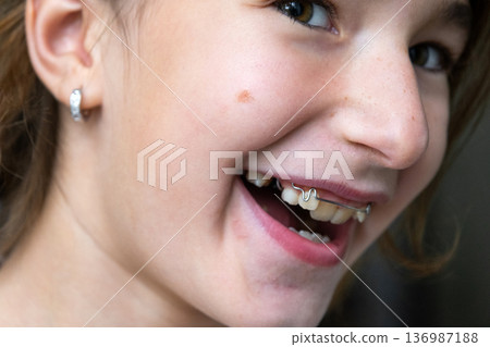 Close-up girl's mouth, visible orthodontic plate, pediatric correction for dental arch and healthy bite. Close-up girl's mouth, visible orthodontic plate, pediatric correction for dental arch and healthy bite. 136987188