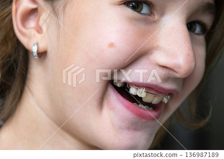 Joyful girl with corrected smile after orthodontic plate, healthy teeth and confident look. 136987189