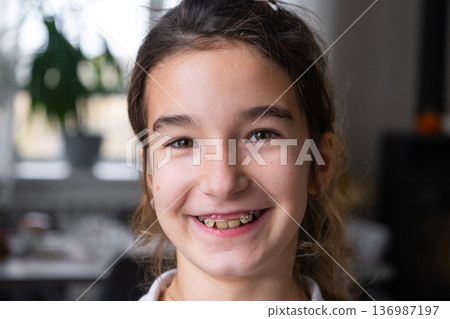 Portrait, girl after orthodontic plate, pediatric appliance for early correction of bite, healthy smile. Portrait, girl after orthodontic plate, pediatric appliance for early correction of bite, healthy smile. 136987197