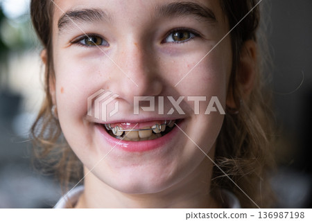 Girl smiles confidently after correction plate, visible improvement in tooth alignment, pediatric orthodontics. Girl smiles confidently after correction plate, visible improvement in tooth alignment, pediatric orthodontics. 136987198