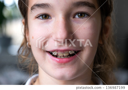 School-age girl with straightened teeth, orthodontic plate for pediatric dental alignment and bite correction. School-age girl with straightened teeth, orthodontic plate for pediatric dental alignment and bite correction. 136987199