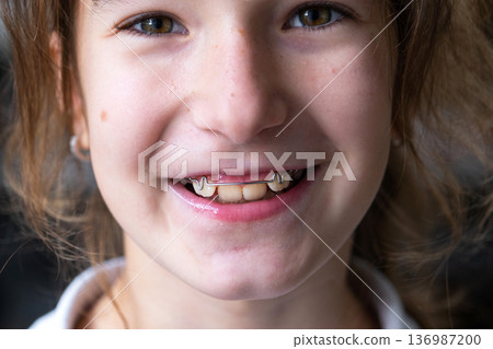 Portrait after plate correction, healthy and aligned smile, successful pediatric orthodontic care. 136987200