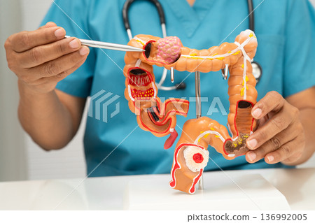 Colorectal cancer, doctor holding intestine colon human anatomy model. Colorectal cancer, doctor holding intestine colon human anatomy model. 136992005
