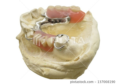 Partial removable denture on dental cast for prosthetic restoration Partial removable denture on dental cast for prosthetic restoration 137008190