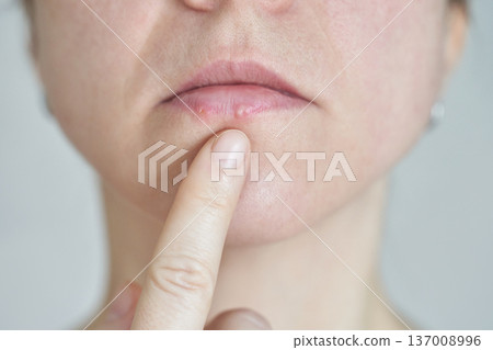 Caucasian female with chapped lips touching mouth skincare, dryness, health awareness, close-up Caucasian female with chapped lips touching mouth skincare, dryness, health awareness, close-up 137008996