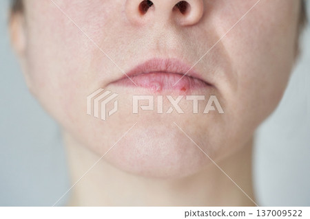 Close-up of adult caucasian females chapped lips highlighting skin texture and imperfections Close-up of adult caucasian females chapped lips highlighting skin texture and imperfections 137009522