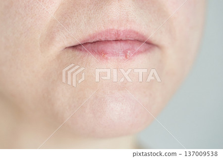 Caucasian female lips with cold sores indicating dryness and irritation in a close-up view Caucasian female lips with cold sores indicating dryness and irritation in a close-up view 137009538