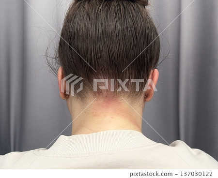 atopic dermatitis in an adult young girl has red scaly spots on the back of the neck close-up atopic dermatitis in an adult young girl has red scaly spots on the back of the neck close-up 137030122