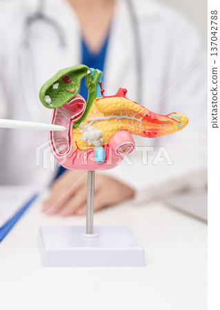 Doctor with human Pancreatitis anatomy model with Pancreas, Gallbladder, Bile Duct, Duodenum, Small intestine. Pancreatic cancer, Acute and Chronic pancreatitis, Digestive system and Health concept 137042788