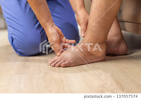 Elderly woman has edema or swelling foot. Elderly woman has edema or swelling foot. 137057574