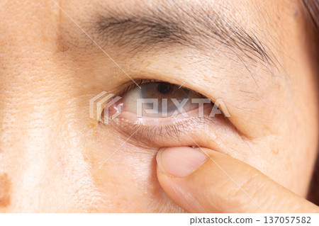 Senior woman has cataract. Generally, cataracts are common in older people. 137057582