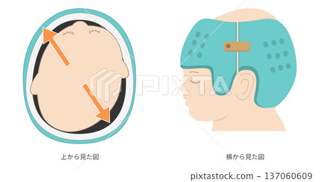 Illustration showing how helmet therapy for plagiocephaly works (cranial correction through growth guidance) Illustration showing how helmet therapy for plagiocephaly works (cranial correction through growth guidance) 137060609
