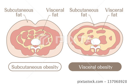 圖示比較皮下脂肪肥胖和內臟脂肪肥胖 137068928