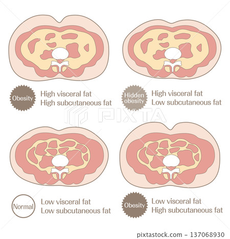 肥胖類型與脂肪分佈分類圖示（正常、肥胖、隱性肥胖） 137068930