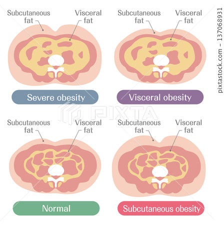 Illustration comparing obesity levels and fat types (severe obesity, visceral fat, subcutaneous fat, normal) 137068931