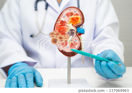 Chronic kidney disease, doctor with model for treatment urinary system, urology, Estimated glomerular filtration rate eGFR. Chronic kidney disease, doctor with model for treatment urinary system, urology, Estimated glomerular filtration rate eGFR. 137069963