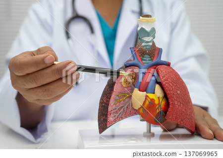 Pneumonia, lung cancer, Asian doctor holding human model. 137069965
