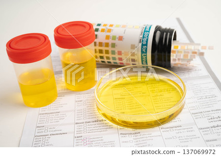 Urinalysis, urine cup with reagent strip pH paper test and comparison chart in laboratory. Urinalysis, urine cup with reagent strip pH paper test and comparison chart in laboratory. 137069972