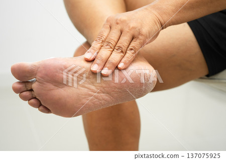 Asian woman check feet with crack and dry heel skin, Diabetic Foot. 137075925