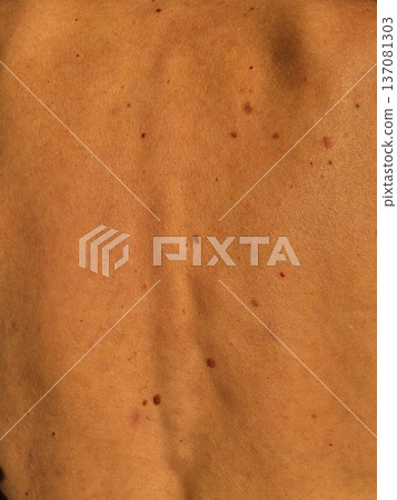 Close-up of human skin with multiple moles and pigmented nevi on the back. 137081303