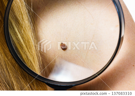 Closeup brown mole on skin. Closeup brown mole on skin. 137083310