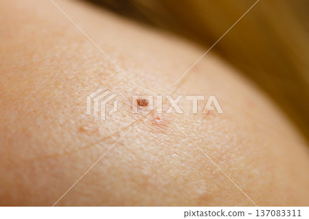 Closeup skin with acne moles and red spots. Closeup skin with acne moles and red spots. 137083311