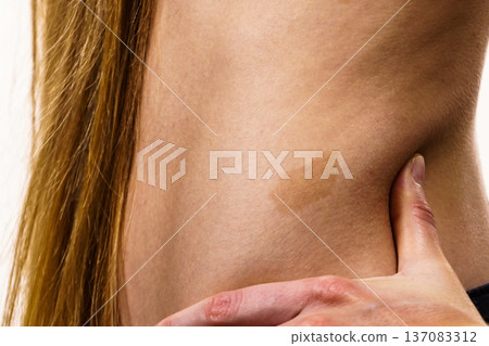 Closeup of brown birthmark on skin Closeup of brown birthmark on skin 137083312