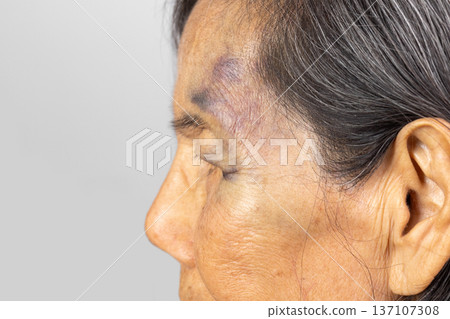 Elderly woman Have A Bruise on Face After Falling in Bathroom. Elderly woman Have A Bruise on Face After Falling in Bathroom. 137107308
