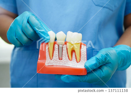 Doctor hold dental implant, artificial tooth roots into jaw, root canal of dental treatment, gum disease, teeth model for dentist studying about dentistry. Doctor hold dental implant, artificial tooth roots into jaw, root canal of dental treatment, gum disease, teeth model for dentist studying about dentistry. 137111138
