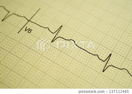 Electrocardiogram (ECG), heart wave, heart attack, cardiogram report. Electrocardiogram (ECG), heart wave, heart attack, cardiogram report. 137111485