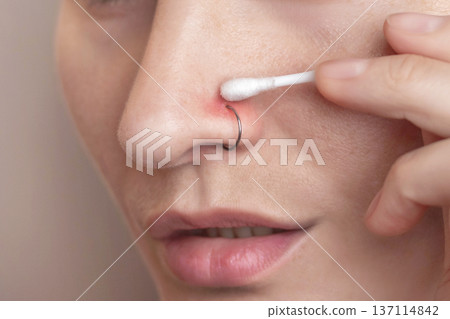 An inflamed nose piercing. A woman swabbing the piercing site with chlorhexidine on a cotton swab. Post-piercing care. Close up photo 137114842