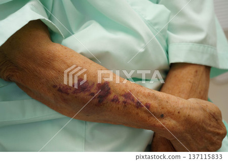 Ecchymosis, elderly bleeding on her arm after taking aspirin. Ecchymosis, elderly bleeding on her arm after taking aspirin. 137115833