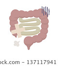 圖示：一條看起來不健康的腸道，上面纏著繃帶。 137117941
