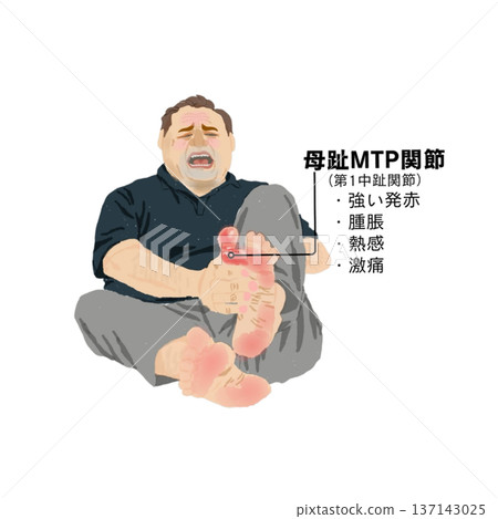 插圖描繪了一位中年男子因痛風發作,大腳趾蹠趾關節出現嚴重的紅腫、發熱和疼痛。 插圖描繪了一位中年男子因痛風發作,大腳趾蹠趾關節出現嚴重的紅腫、發熱和疼痛。 137143025