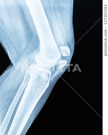 Close up x-ray scan of a knee joint. Doctor examining for diagnosis. Close up x-ray scan of a knee joint. Doctor examining for diagnosis. 137163163