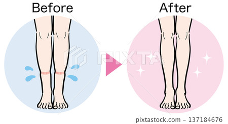 腿部輕微腫脹（襪印）前後對比 137184676