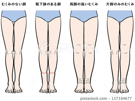 腿部腫脹症狀對比（襪印、雙腿腫脹、單腳腫脹） 137184677