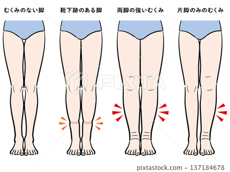 腿部腫脹症狀對比（襪印、雙腿腫脹、單腳腫脹） 137184678