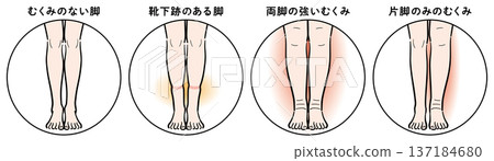 腿部腫脹症狀對比（襪印、雙腿腫脹、單腳腫脹） 137184680
