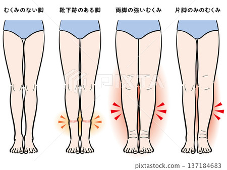 腿部腫脹症狀對比(襪印、雙腿腫脹、單腳腫脹) 腿部腫脹症狀對比(襪印、雙腿腫脹、單腳腫脹) 137184683