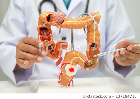 Colorectal cancer, doctor holding intestine colon human model. 137184713