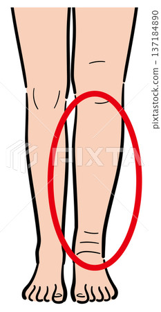只有一條腿腫脹 137184890