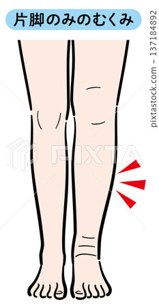 只有一條腿腫脹 137184892