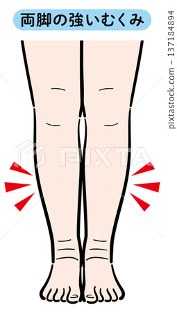 Severe swelling in both legs 137184894