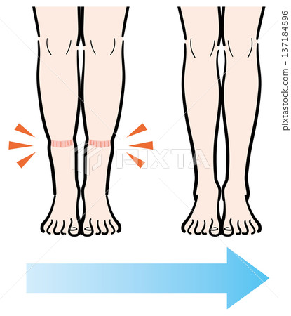 腿部輕微腫脹（襪子印記）變成腿部腫脹消失 137184896