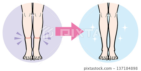 腿部輕微腫脹（襪子印記）轉變為完全消失 137184898